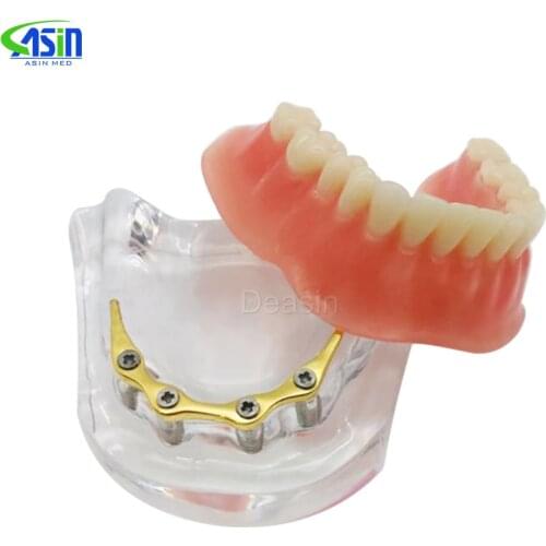 Repair teeth implant model with golden bar Denture Teeth mandibular model Dental Teaching Model