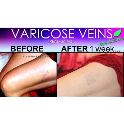NATURAL VARICOSE VEIN TREATMENT & SPIDER VEIN TREATMENT 2 IN 1 STIMULATING OIL