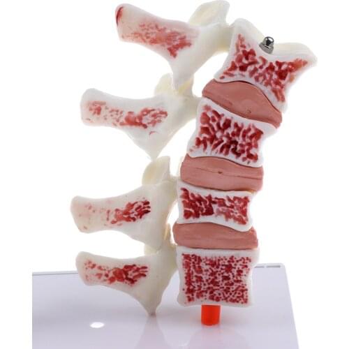 1:1 Human Medical Lumbar Vertebra Thighbone Osteoporosis Pathology Model Kit