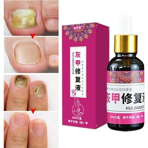 Nail Fungal Treatment Feet Care Essence Nail Foot Whitening Toe Nail Fungus Removal Gel Anti Infection Paronychia Onychomycosis