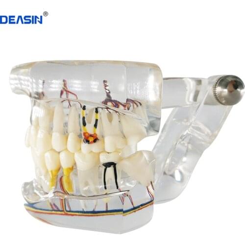 1pcs Dental Nerve Teaching Teeth Model Implant with Transparent Pathological Repair Teaching Demonstration model