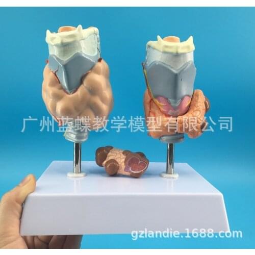 Human thyroid pathology Hyperthyroidism anatomical model Thyroid tumor medical model