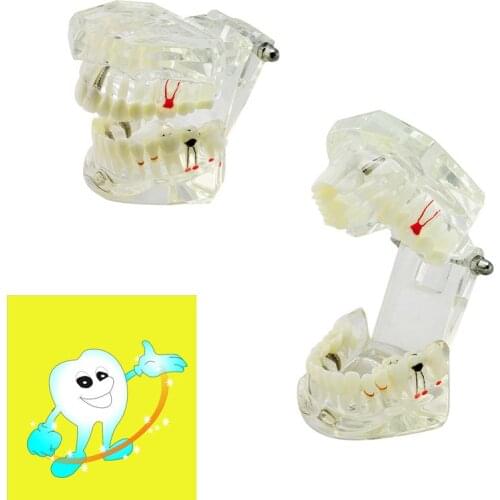 Dental Demonstrative Implant Disease Teeth Model with Restoration+ Bridge Tooth