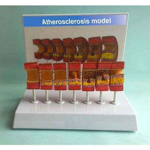 Atherosclerosis model blood vessel thromboembolism model arterial blood vessel medical teaching instrument
