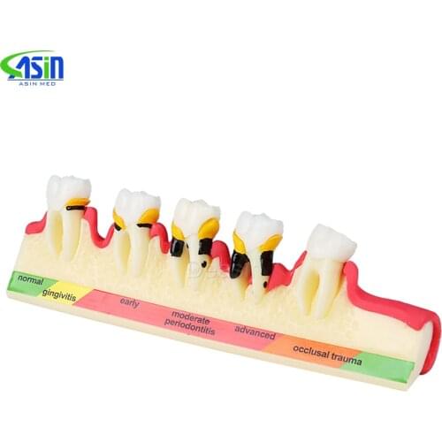 Oral Teeth Model Periodontal Disease Model Teeth Pathology Model Medical Teaching Aids Dentist Teaching Equipment