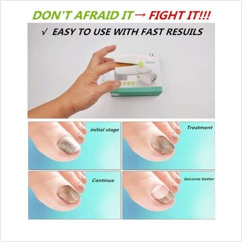 NEW Home Use Cure Toe Nail Fungus Blue Light and Laser Light Therapy Device Onychomycosis Anti Fungal LLLT Physiotherapy