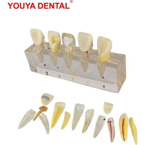 Transparent Dental Teeth Model For Studying Teaching Dental Pulp Disease Clinical Model Medical Science Oral Dentistry Products