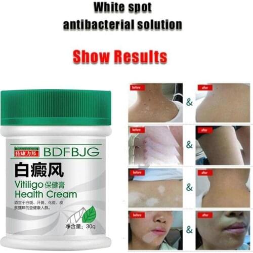 White Spot Disease Treatment Ointment Leukoplakia Disease Repair Vitiligo Pigment Cream Skin Melanin Chinese Medical Balm C O5A5
