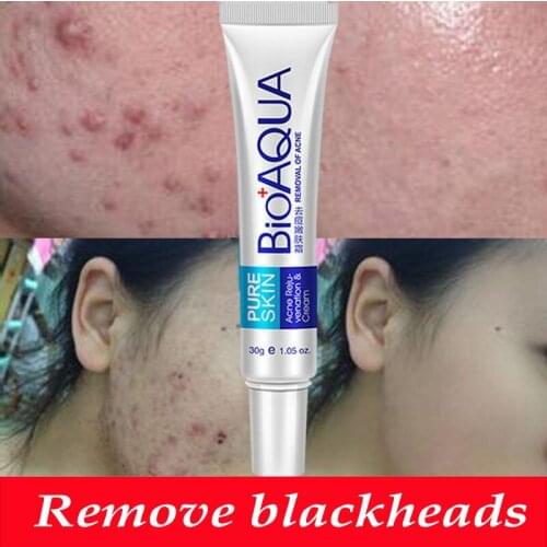 Pure Skin Acne Rejuvenation Cream Removal Treatment Blackhead Anti Oil Control Shrink Pores Scar Remove Face Care Whitening
