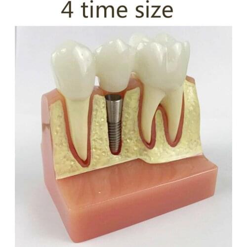 4 time tooth implant model Communication between doctors and patients in dental model tooth plant pratice