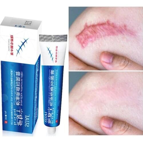 Acne Scar Cream New Old Scars Repair Acnes Pimple Dark Spots Stretch Marks Treatment Whitening Cream Moisturizing Body Skin Care
