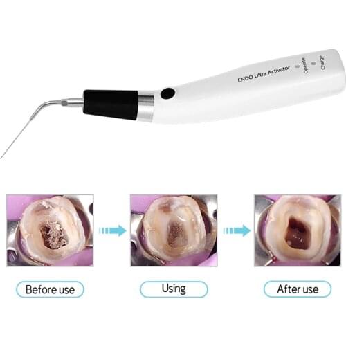 Dental Endo Ultra Activator Endo Irrigator Cordless Ultrasonic Activator Handpiece with 6 Tips 40-50Khz 1500mAh