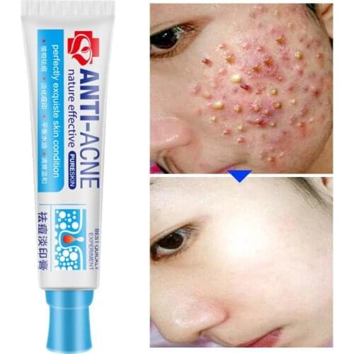 Traditional Chinese Medicine Acne Treatment Shrink Whitening Moisturizing Pores Creams Cream Gel Face Bleaching Spots H8Y6