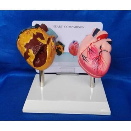 1:1 LifeSize Human Smoking Heart Vs Normal Heart Comparison Model Heart Anatomy Model Human Heart Anatomy Medical Teaching Model