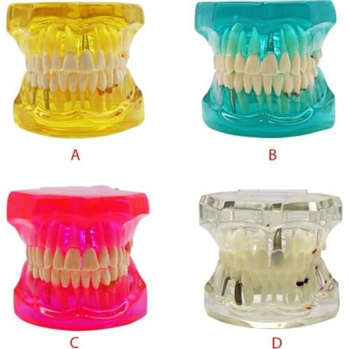 Detachable Dental Teeth Model With Restoration Bridge Tooth Dentist For New Dentist Traning Dental Teaching Study