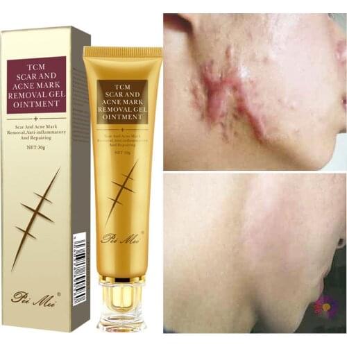 Effective Acne Scar Removal Cream Pimples Stretch Marks Face Gel Remove Acne Smoothing Whitening Moisturizing Body Skin Care 30g