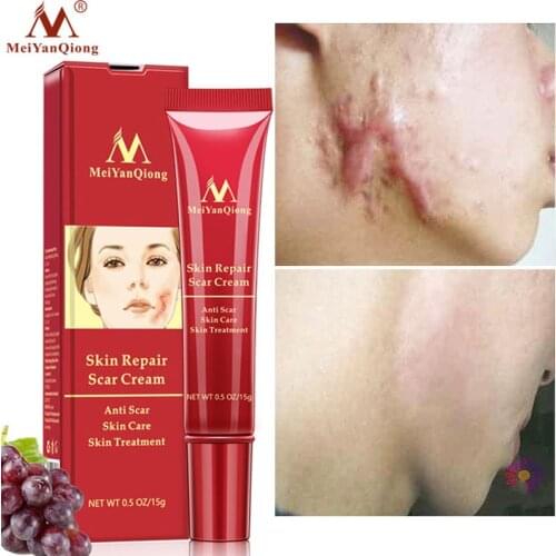Scar Removal Face Cream Acne Scars Gel Stretch Marks Surgical Scar Burn For Body Pigmentation Corrector Acne Spots Repair Care