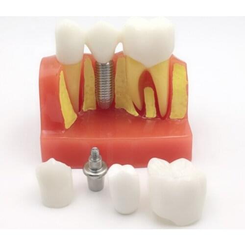 4X implant dental model oral teeth model dental teaching demonstration model