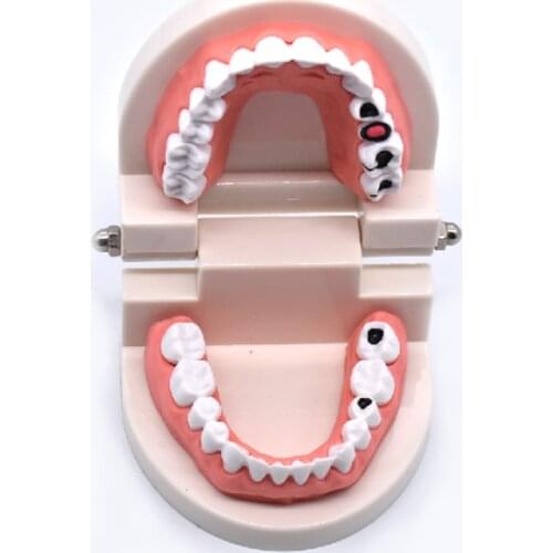 Dental Study Teaching Teeth Model decayed tooth decay dental caries Tooth Care Education Dentist Equipment Denture