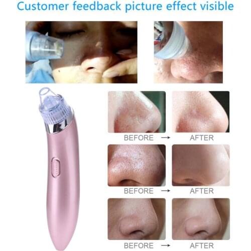 Face Acne Black Dot Pimple Blackhead Remover Electric Microcrystalline Blackhead Vacuum Cleaner Pore Blackhead Skin Care Machine