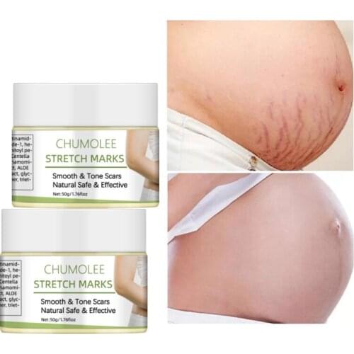 CHUMOLEE Stretch Marks Remover Cream Eliminate Pregnancy Scars Maternity Repair Anti Winkle Skin Firming Body Cream