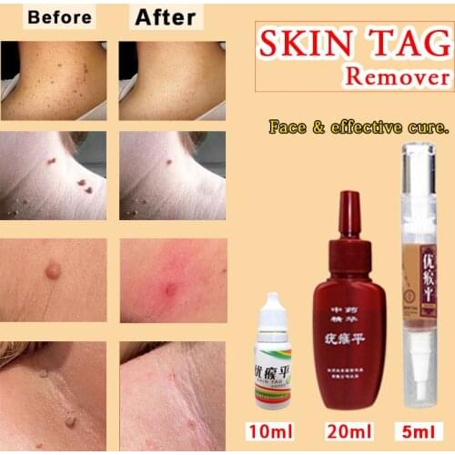 Rapidly Removes Moles Skin Tag Fast Removal Mole & Genital Wart Foot Corn Treatment Kit Repair Natural Bacteriostatic Liquid