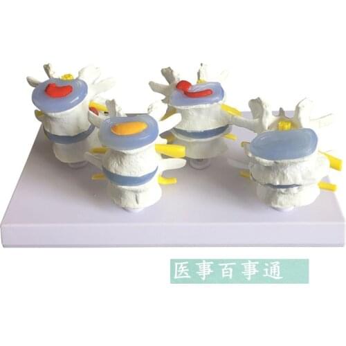 Demonstration Model Lumbar Vertebral Spine Model Pathological vertebrae model Quadrilateral lumbar disease model medical art