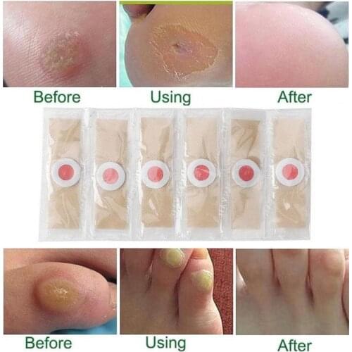 6pcs Medical Plaster Foot Corn Removal Remover Warts Thorn Plaster Of Calluses Patch Callosity Detox Foot Pad Curative Plasters