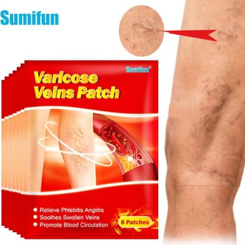 6/18/36Pcs Varicose Veins Plaster Treatment Angiitis Spider Leg Vasculitis Phlebitis Care Removal Patch Medical Herbal Sticker