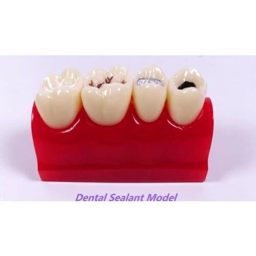1pcs Dental Pit Fissure Caries Sealant Study Model Silver Amalgam Teach Study