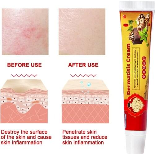 Sumifun Psoriasis Cream Skin Care Cream Psoriasis Skin Cream Dermatitis Eczematoid Eczema Ointment Treatment 20g