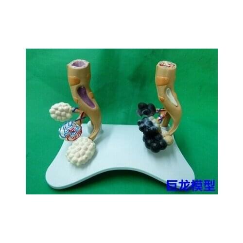 Human Lung anatomy pathology Lung model and Healthy lungs comparative free shipping