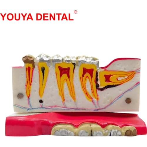 Dental Model Teeth Modeling Right Side Posterior Tissue Decomposition Teaching Model Medical Science Dentist Dentistry Products