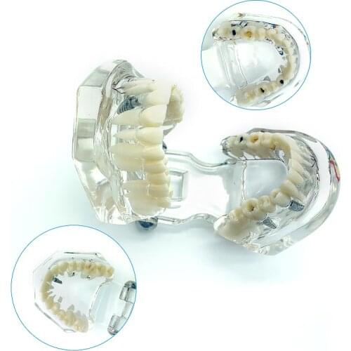 Dental Teeth Model Pathologies Repair Model with Nerve Teaching Model Dentistry Products