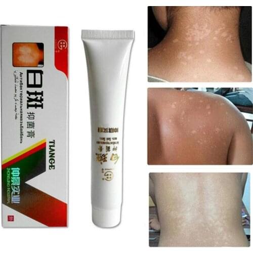 White Spot Disease Cream Pigment Melanin Promoting Liniment Skin Vitiligo Leukoplakia Disease Treatment plaster Massage Cream