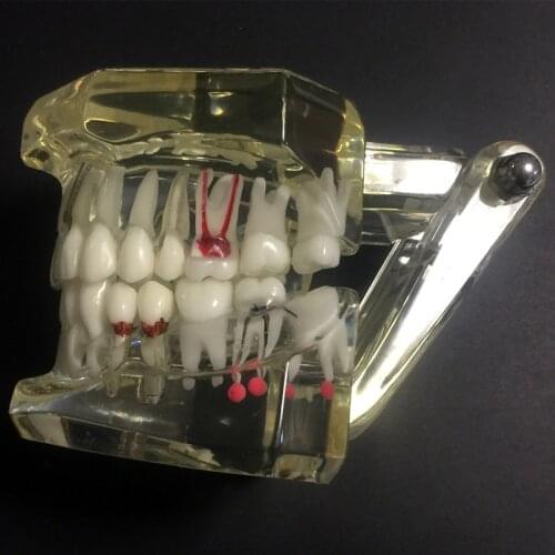 Dental Implant Disease Teeth Model With Restoration Bridge Malocclusion Orthodontic Model For Medical Science Dental Research