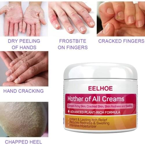 EELHOE Skin Psoriasis Cream Dermatitis Eczematoid Eczema Ointment Treatments Psoriasis Cream Skin Care Cream Cosmetics TSLM2
