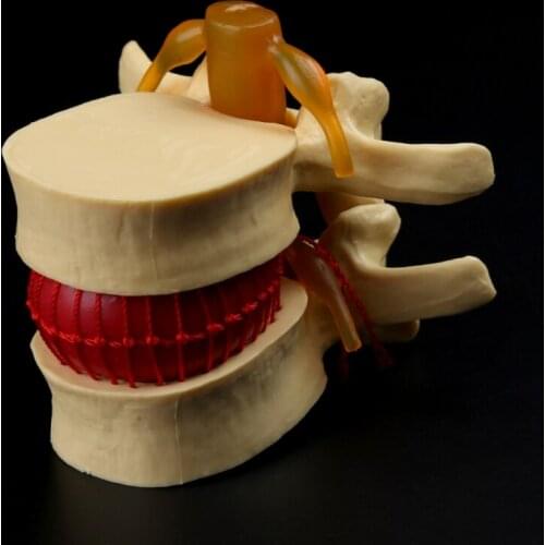 Anatomical Spine Lumbar Disc Herniation Anatomy Teaching Tool