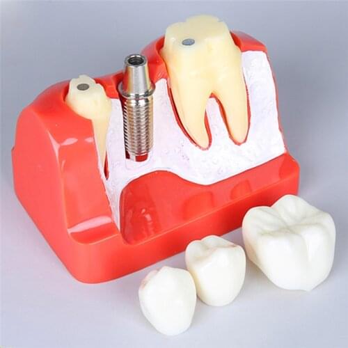 4 Times Dental Implant Disease Model Analysis with Restoration Crown Bridge Demonstration Dental Teeth Model for Teaching study