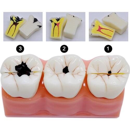 Dental teaching Model patien communication Dissected Caries Model Caries Decomposition Model Oral Dental Tooth Model Dental lab