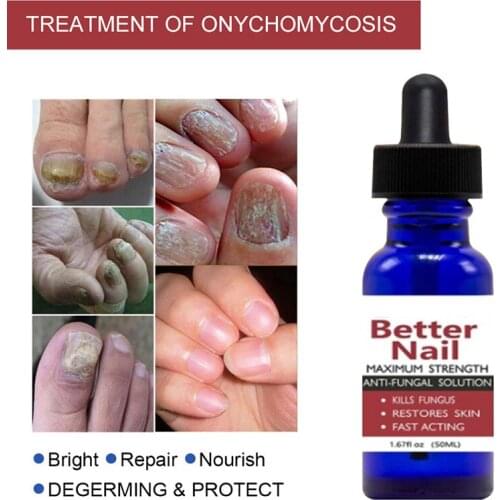 50ml Nail Repair Liquid Anti Fungus Toe Serum Remove Nail Onychomycosis Essence Nail Treatment Liquid Hand Foot Care SANA889