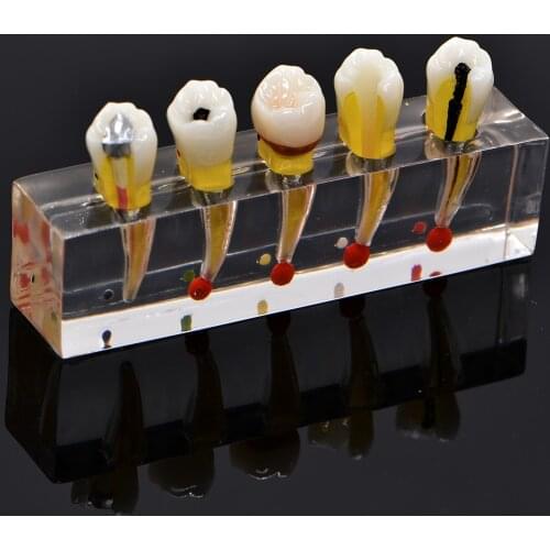 Endodontic pathological model pathology Patient communication model Endodontic treatment Posterior Teeth Dental Pulp Restoration