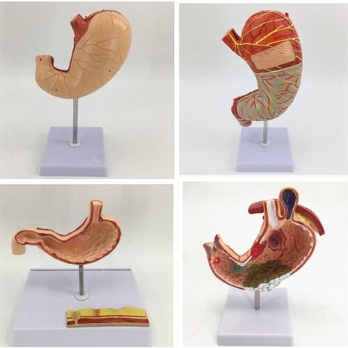 Human stomach anatomy model Stomach lesion Stomach disease demonstration model Pathology stomach Gastric perforation