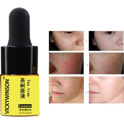 Tea tree essence 5ml Acne Serum Acne Cream Pimple Remover Tool Skin Care Face Cream Facial Serum Essence