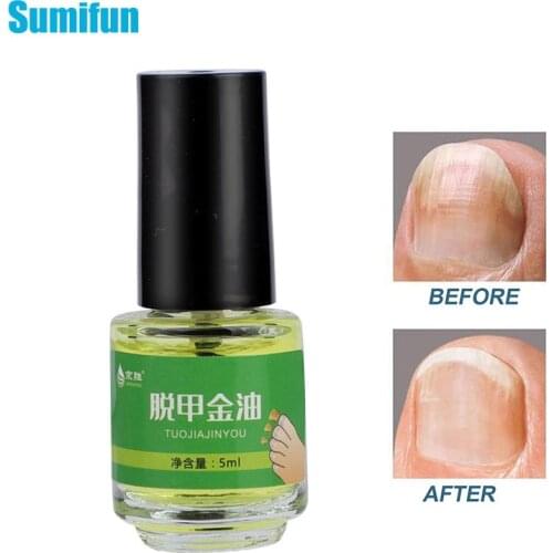 5ml Nail Fungal Treatment Antibacterial Oil Onychomycosis Removal Solution Foot Toe Nail Fungus Infection Repair Essence Cream
