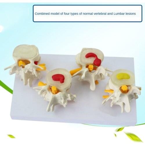 Four Typing Spine Who Had Been Treated with Normal Lumbar Variable Combination Model Lumbar Variable Example Disc Disease