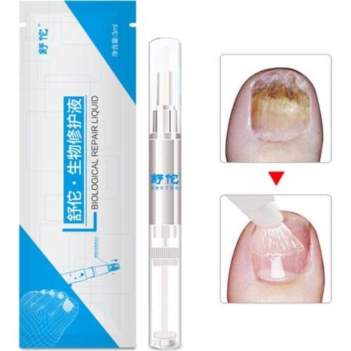 New Hot 3ml Nail Fungus Treatment Liquid Anti Fungal Finger Toe Nails Care SMR88