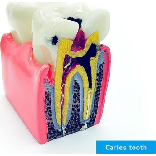 Dental Model Caries Model Dental Teeth Model for Teeth Disease Demonstration Model