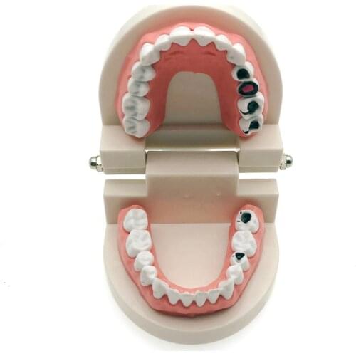 Dental Caries Tooth Study Model Typodont Demonstration Adult Size
