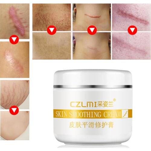 Skin Scars Remove Cream Stretch Marks Cream Treatment Maternity Repair Anti-Aging Anti-Wrinkles Firming Stretch Mark Body Creams